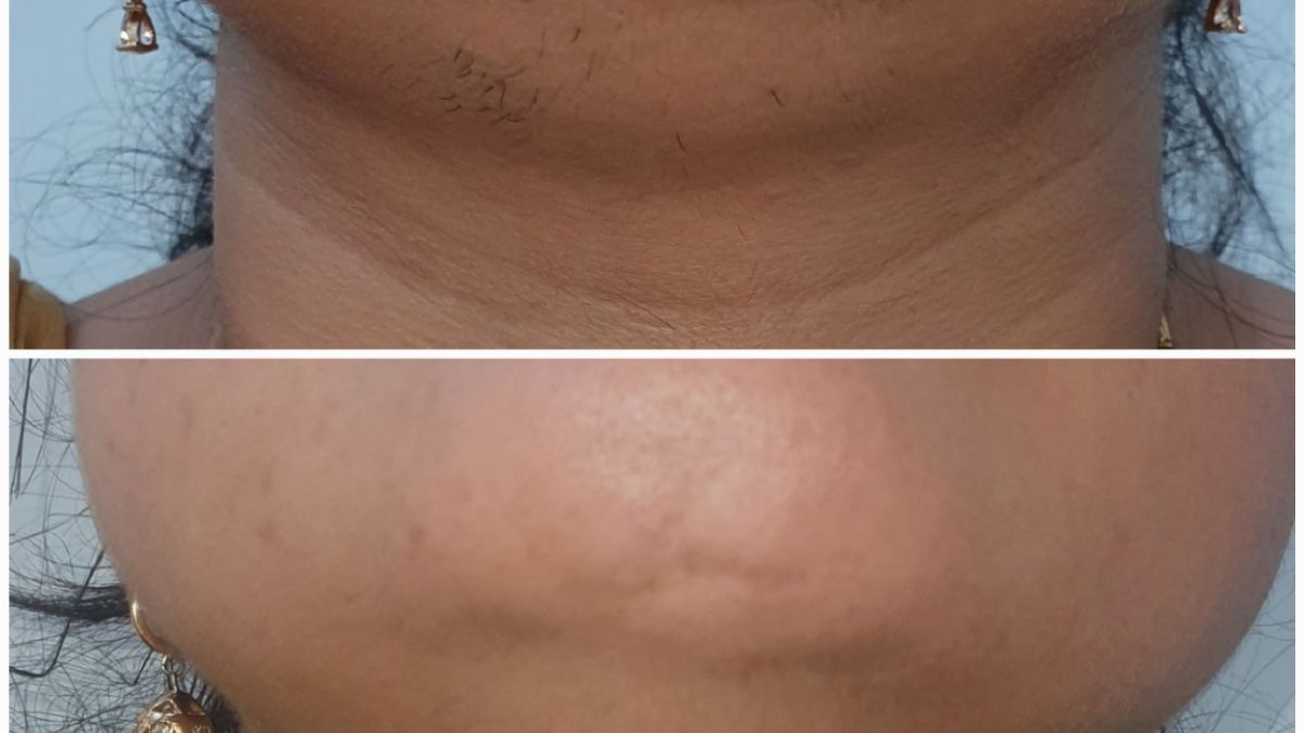 Before after of Laser Hair Reduction - Beautera Hair And Skin Clinic