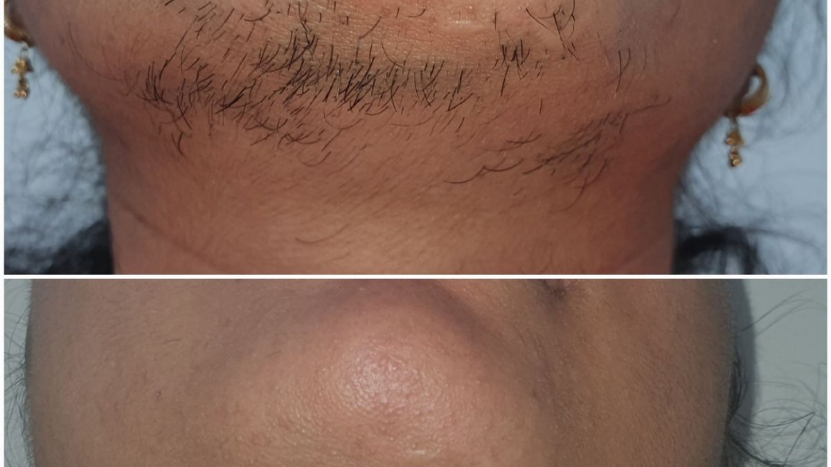 Before after of Laser Hair Reduction - Beautera Hair And Skin Clinic - Dr. Shreyansh