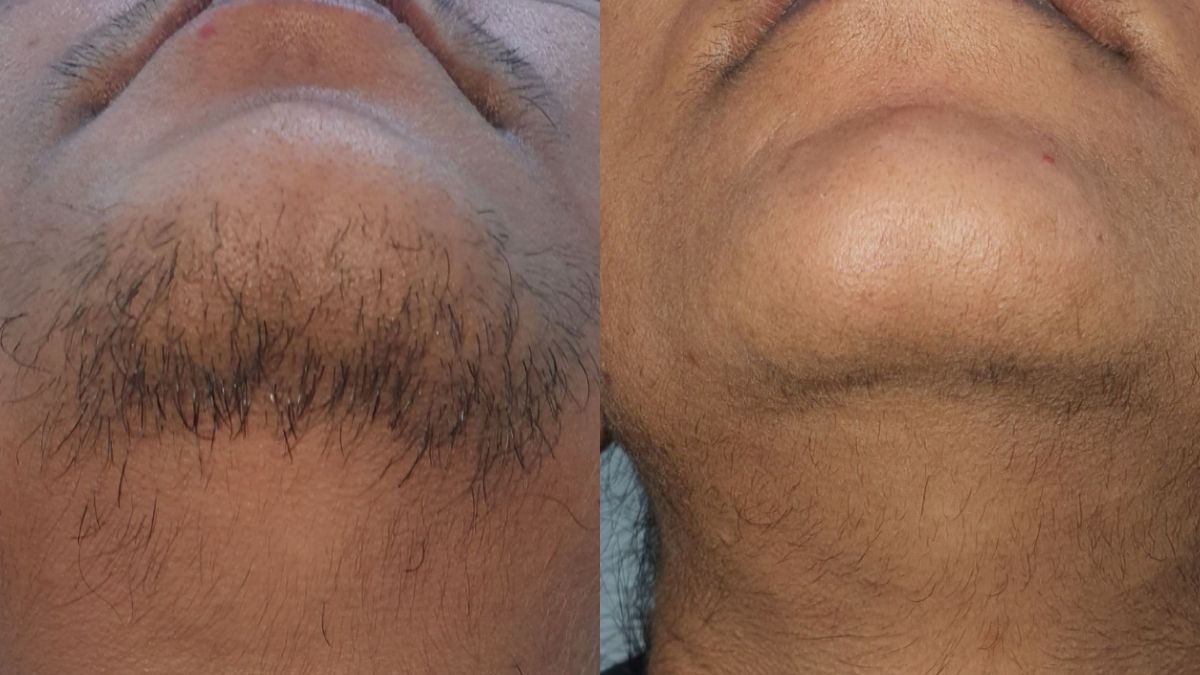 Before after of Laser Hair Reduction - Beautera Hair And Skin Clinic