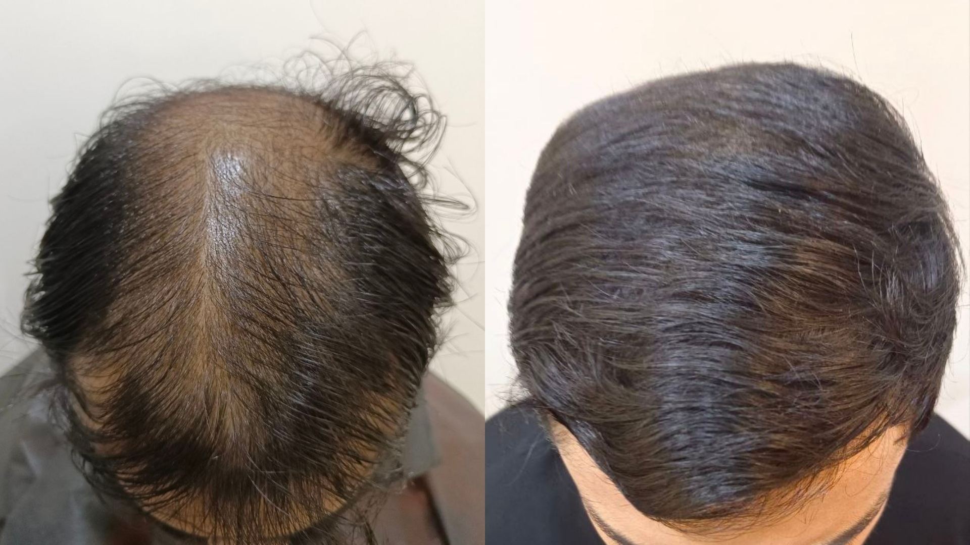 Best GFC Treatment in Kandivali, Mumbai