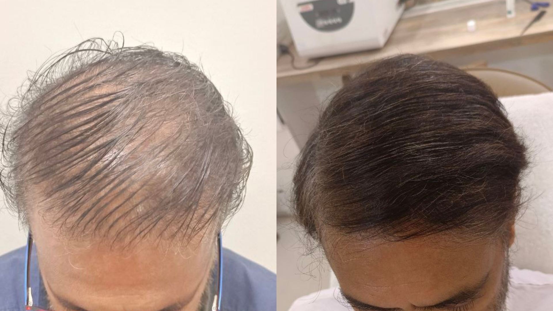 Best GFC procedure in kandivali, Mumbai - Best hair specialist