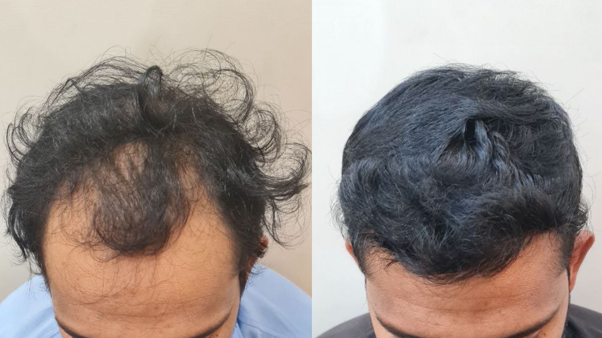 Best Hair Transplant treatment in Kandivali, Mumbai