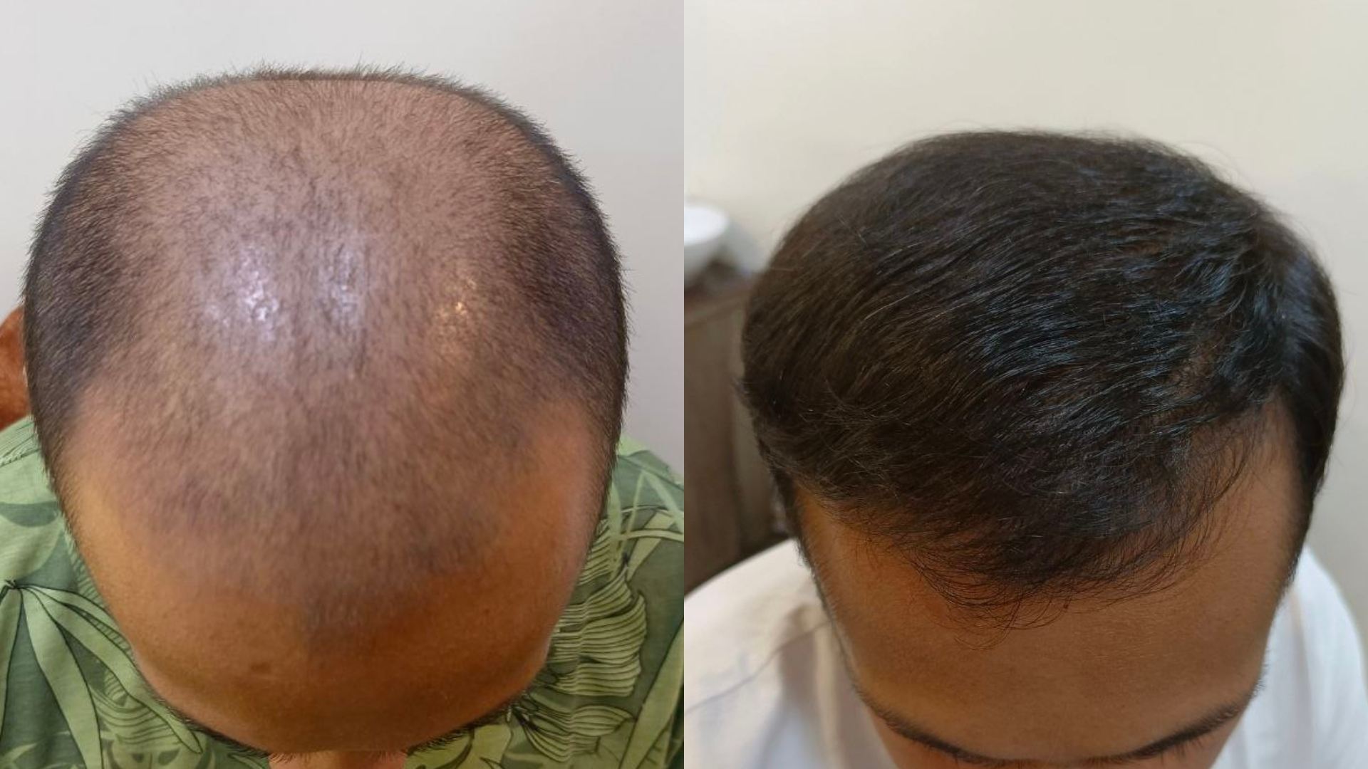 Best Hair Treatment in kandivali, Mumbai - GFC Treatment