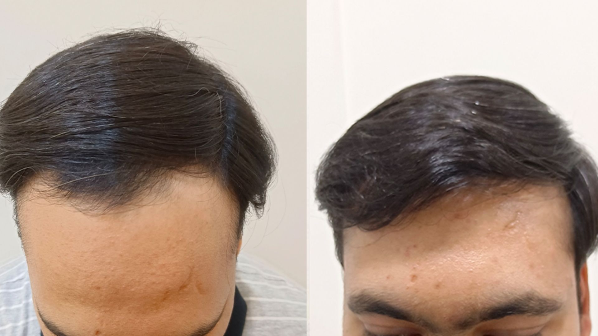 before after Best Hair Transplant treatment in Kandivali, Mumbai