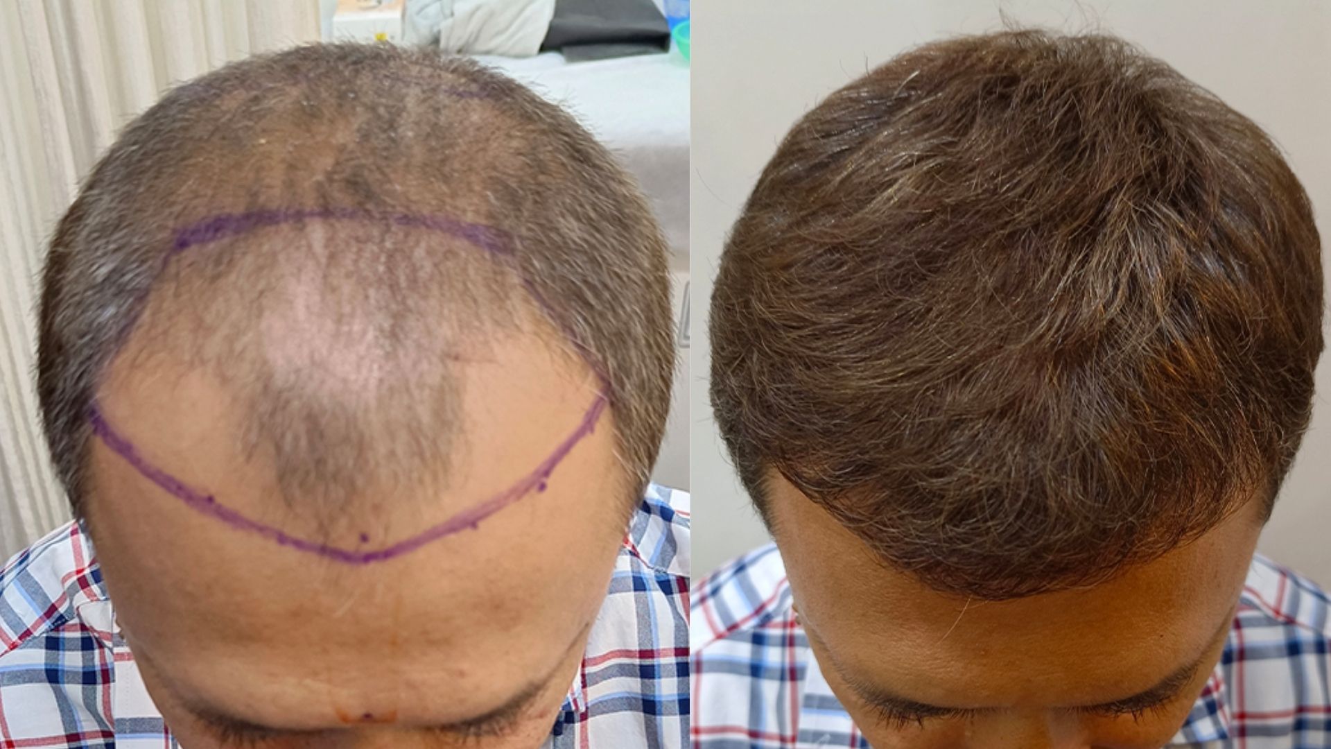 patient before after Best Hair Transplant treatment in Kandivali, Mumbai