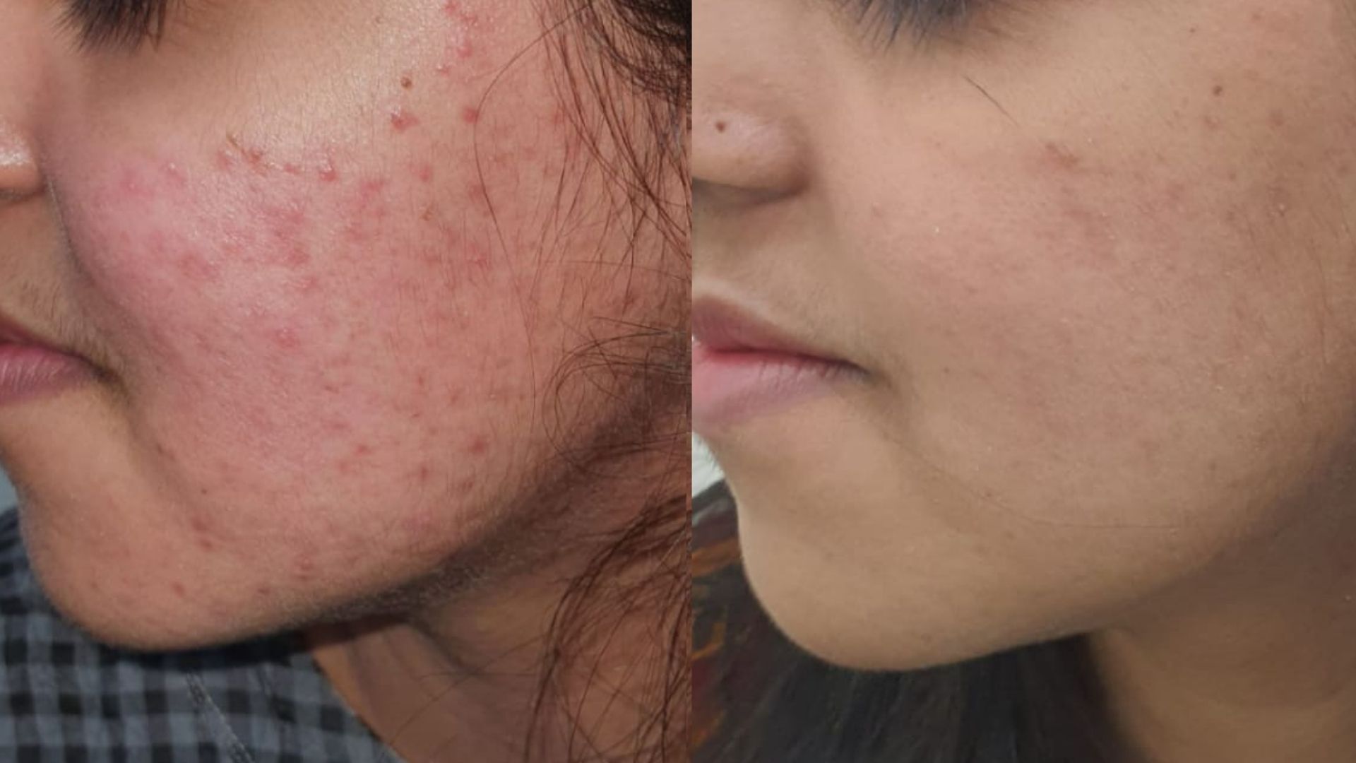 Best Chemical Peel Treatment in Kandivali Mumbai