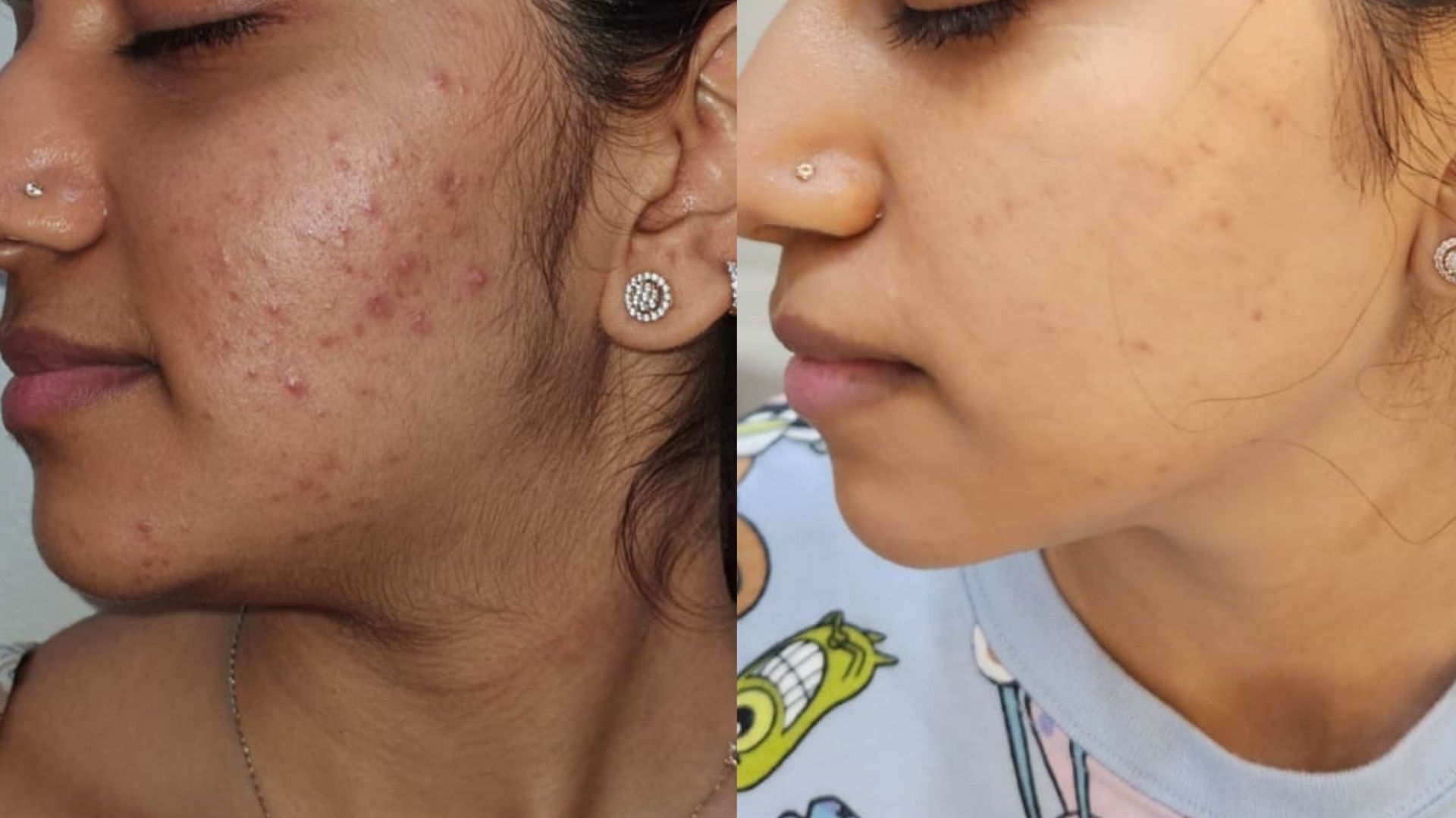 Best Chemical Peel Treatment in Kandivali Mumbai