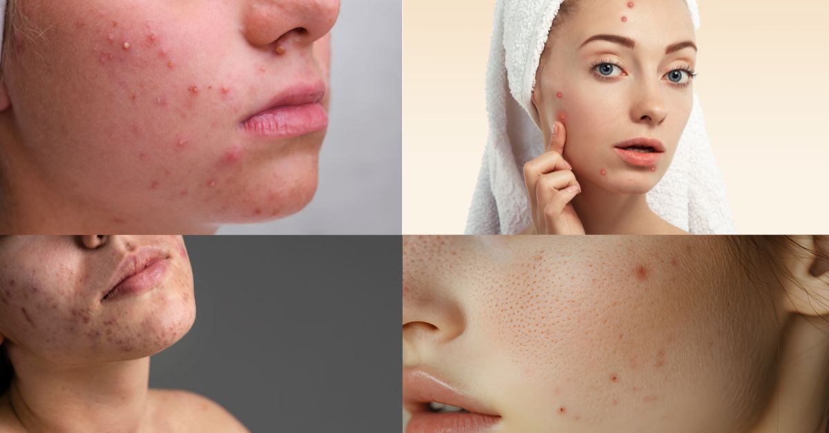 Beautera Hair and Skin Clinic in kandivali