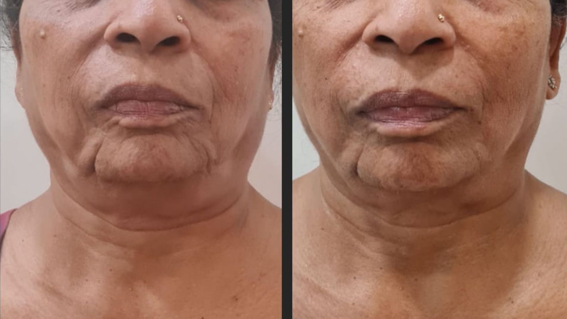 Before-After HIFU treatment in Kandivali Mumbai