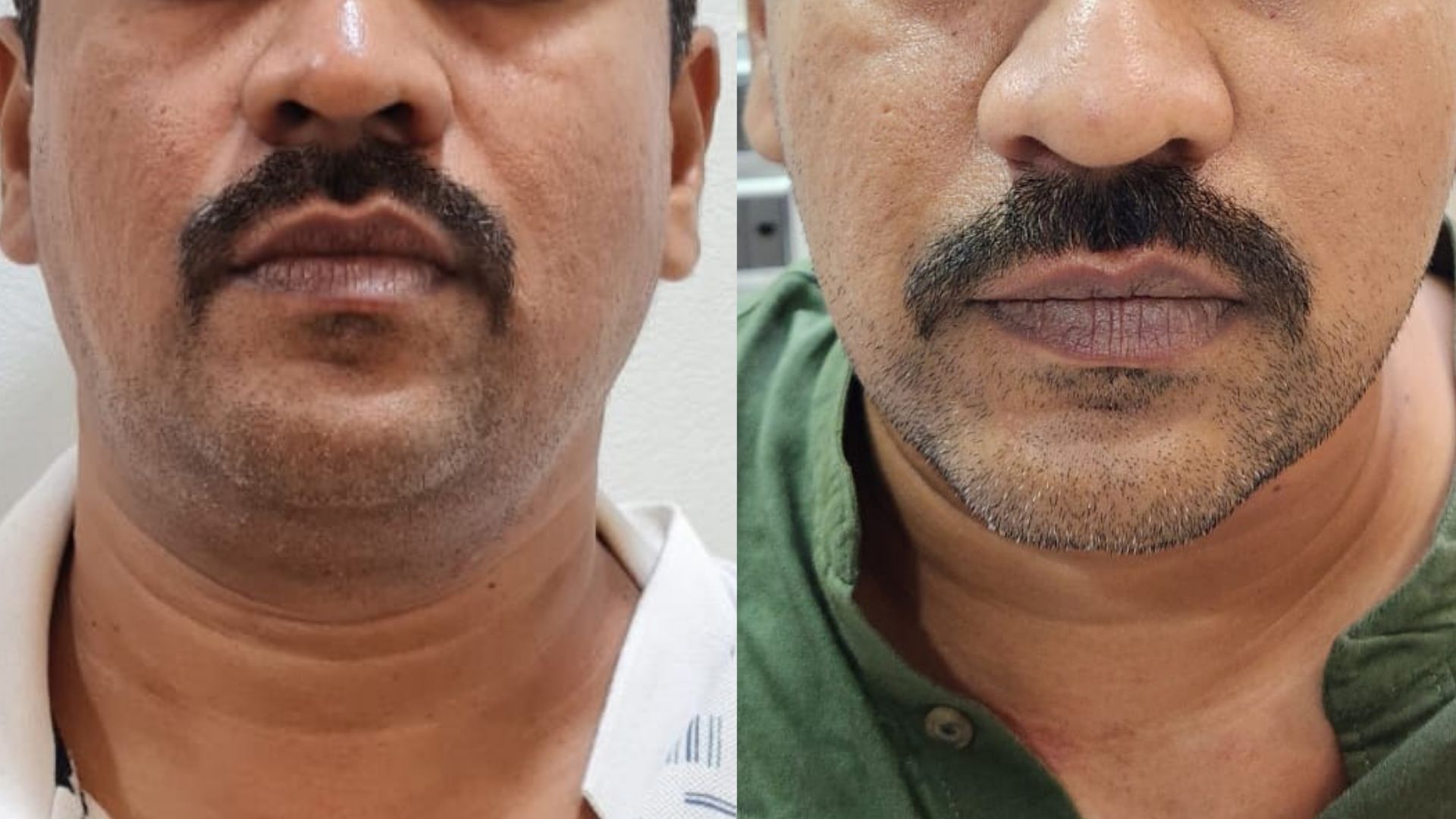 Before After HIFU treatment in Kandivali Mumbai