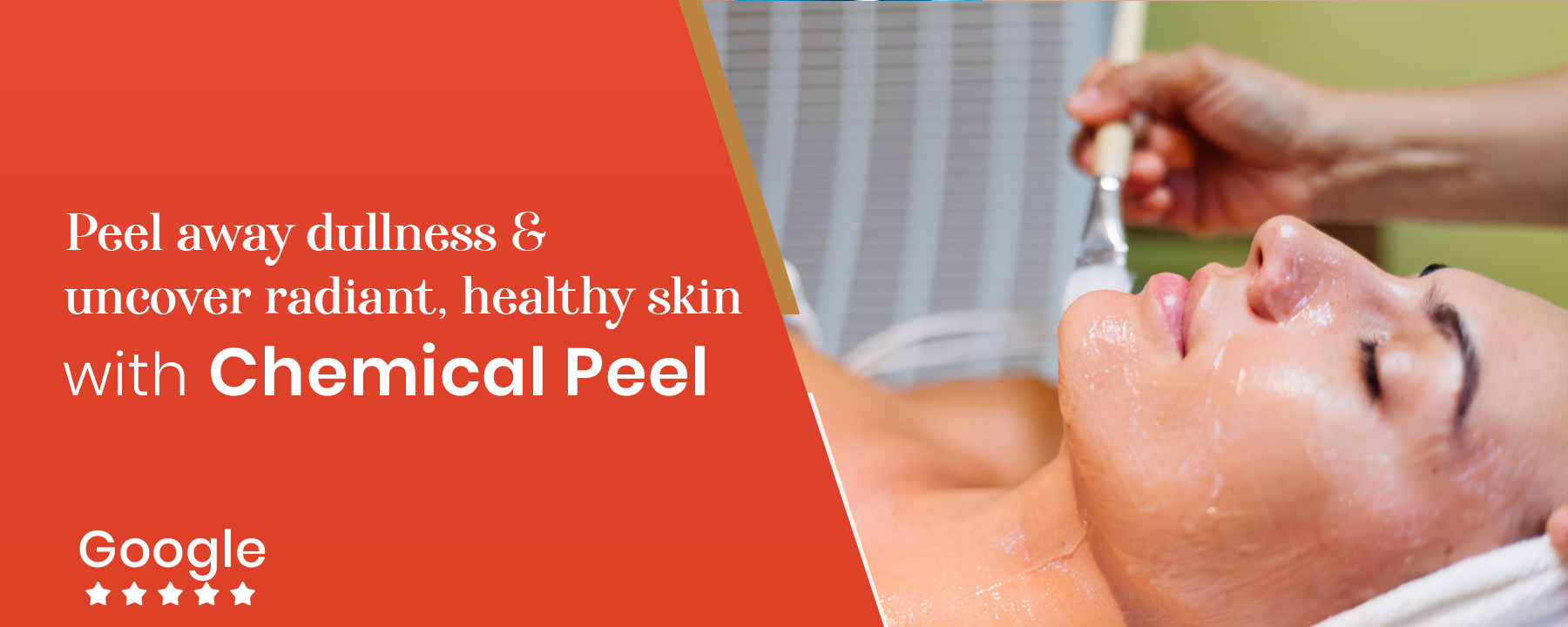 Best Chemical Peel For Acne & Acne scar treatment in Kandivali Mumbai