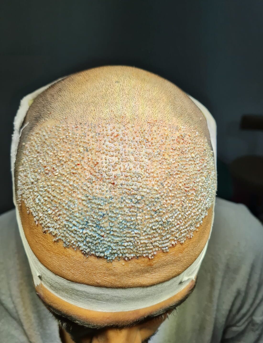 Dr. Shreyansh Talesra - Best Hair Transplant Surgeon in Kandivali Mumbai