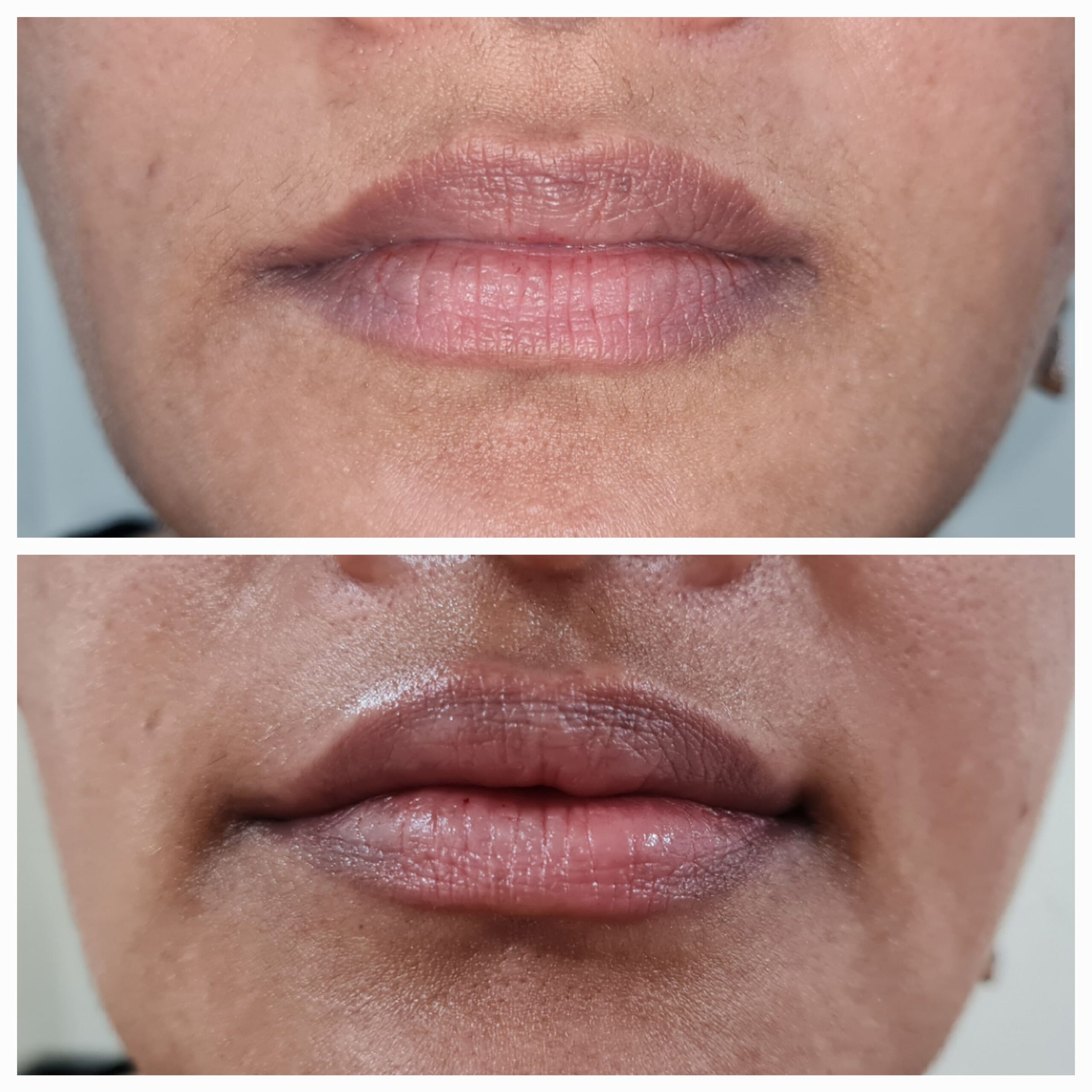 Lip Fillers in Kandivali Mumbai
