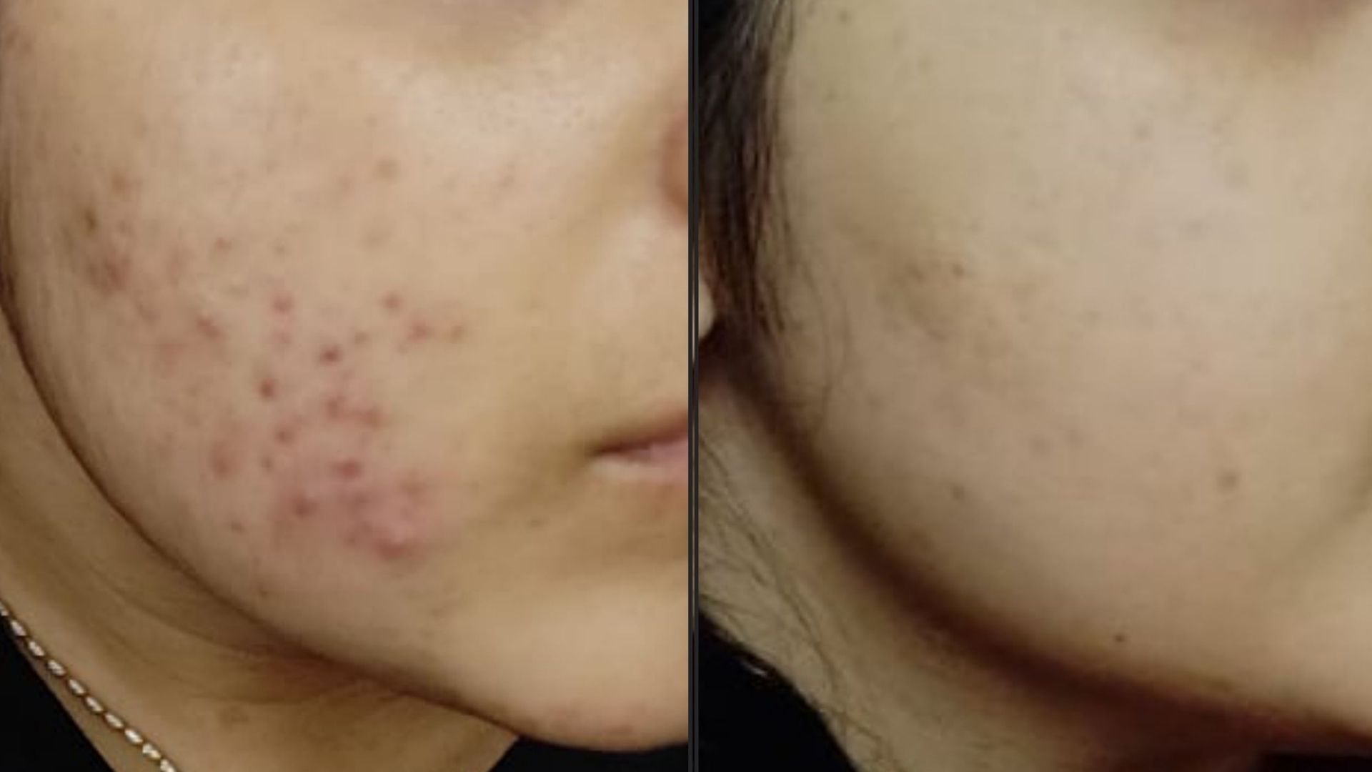 Acne Laser treatment in kandivali mumbai