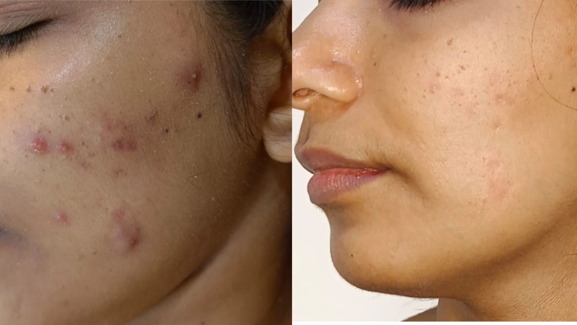 Acne treatment in kandivali mumbai