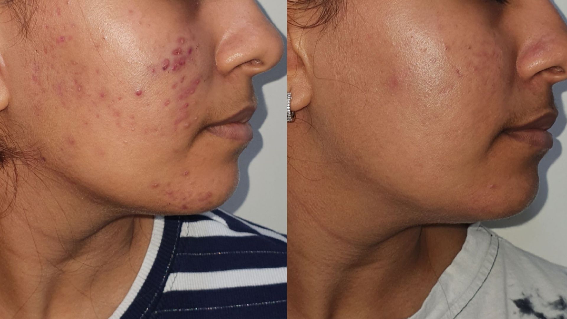 Best Acne scar treatment in kandivali mumba