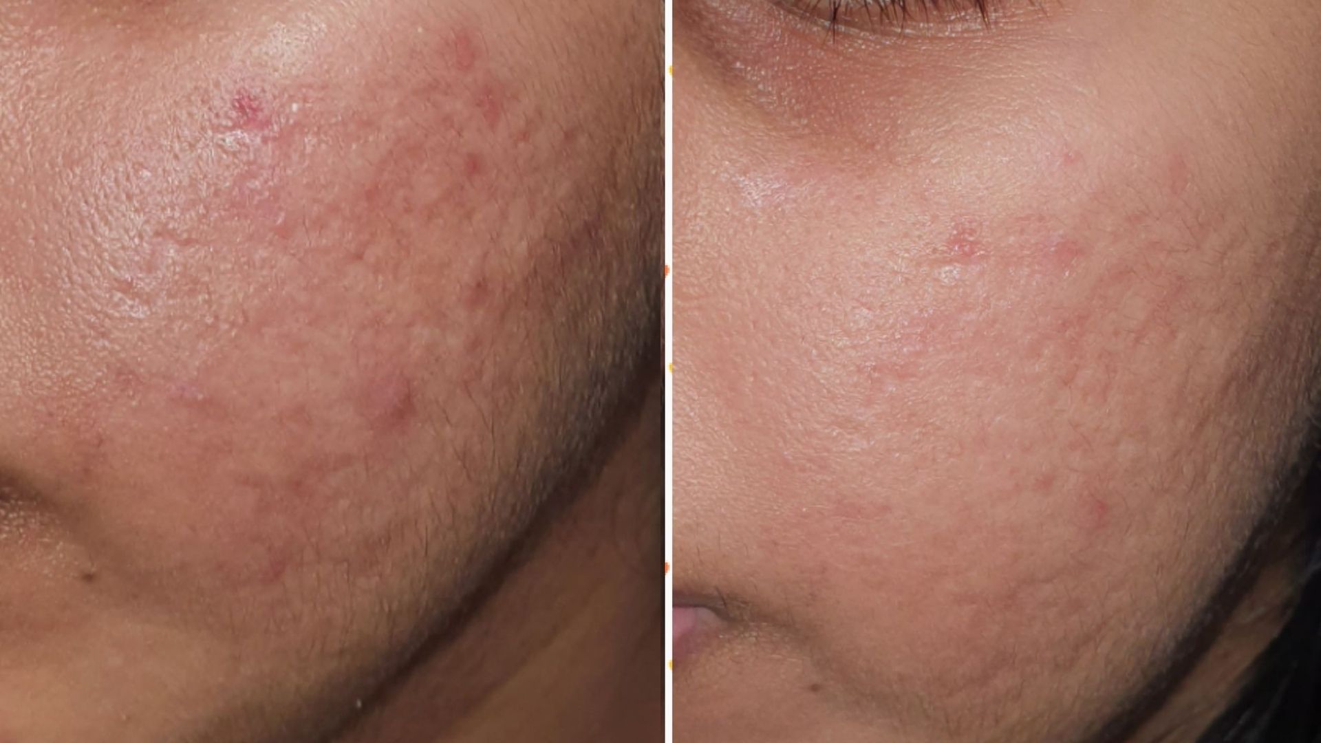 Best Acne treatment in kandivali mumbai