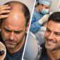 Hair Transplant Treatment in Kandivali Mumbai 85x85