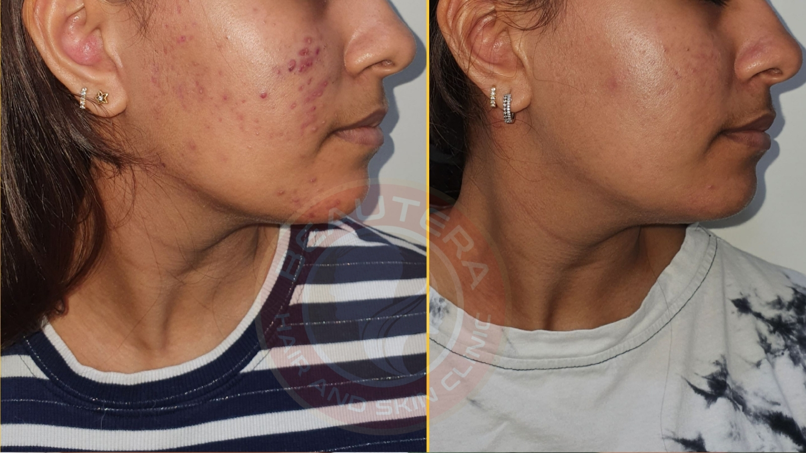 Best Acne & Acne Scar Treatment in Kandivali