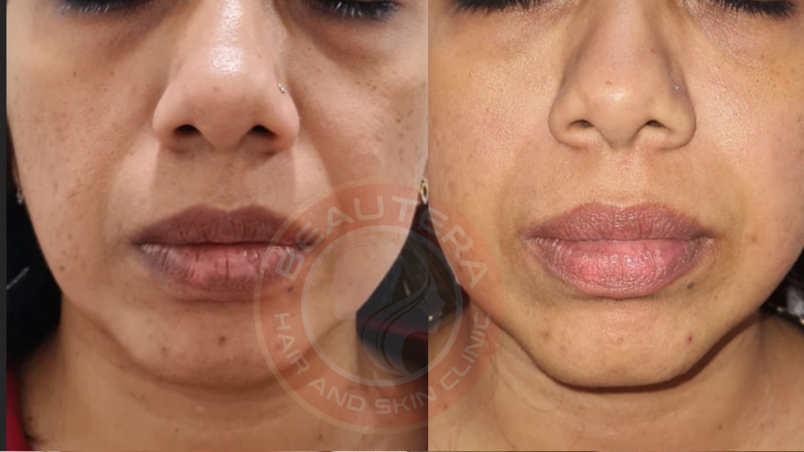 Best Antiaging Treatment HIFU in Kandivali