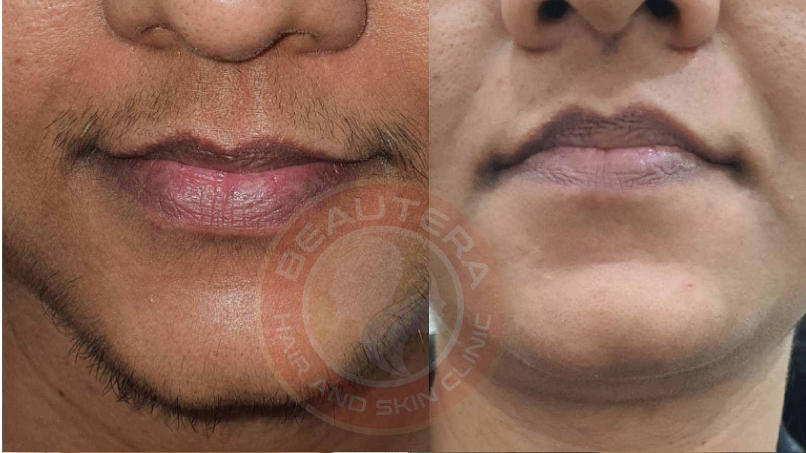 Best Laser Hair Reduction in Kandivali