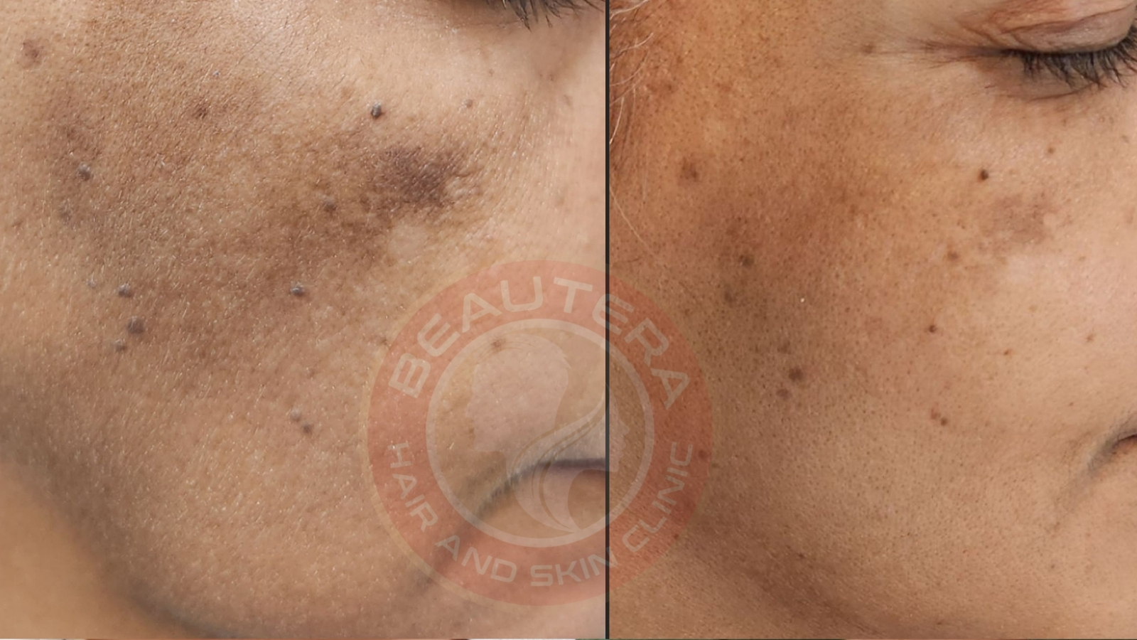 Best Pigmentation Treatment in Kandivali