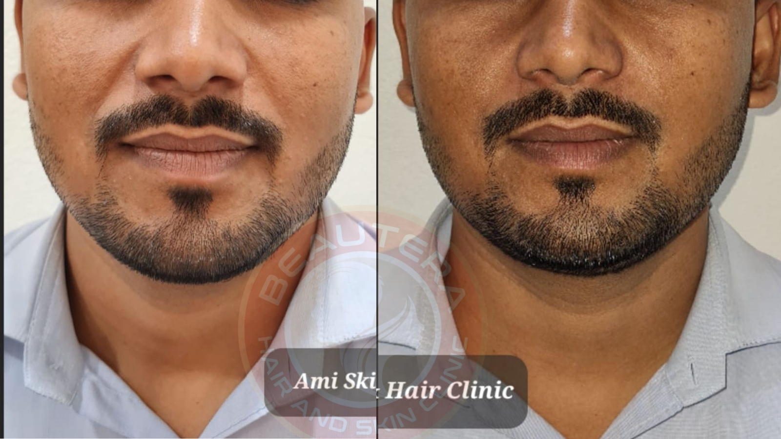 Best Anti Aging Treatment HIFU in Kandivali Mumbai