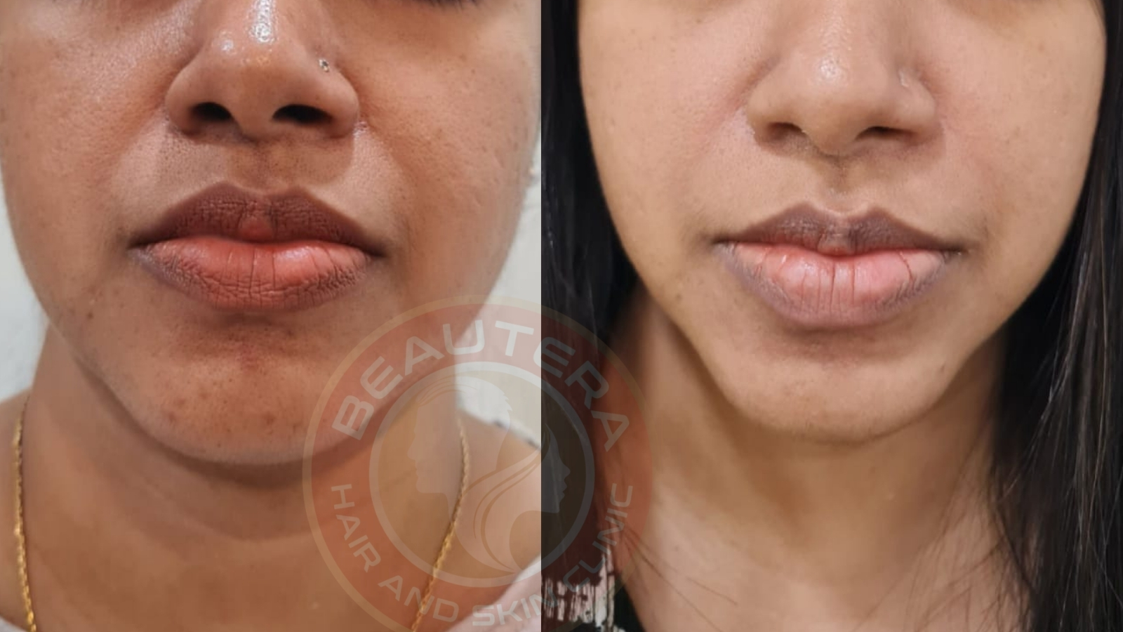 Best HIFU - Antiaging Treatment in Kandivali Mumbai