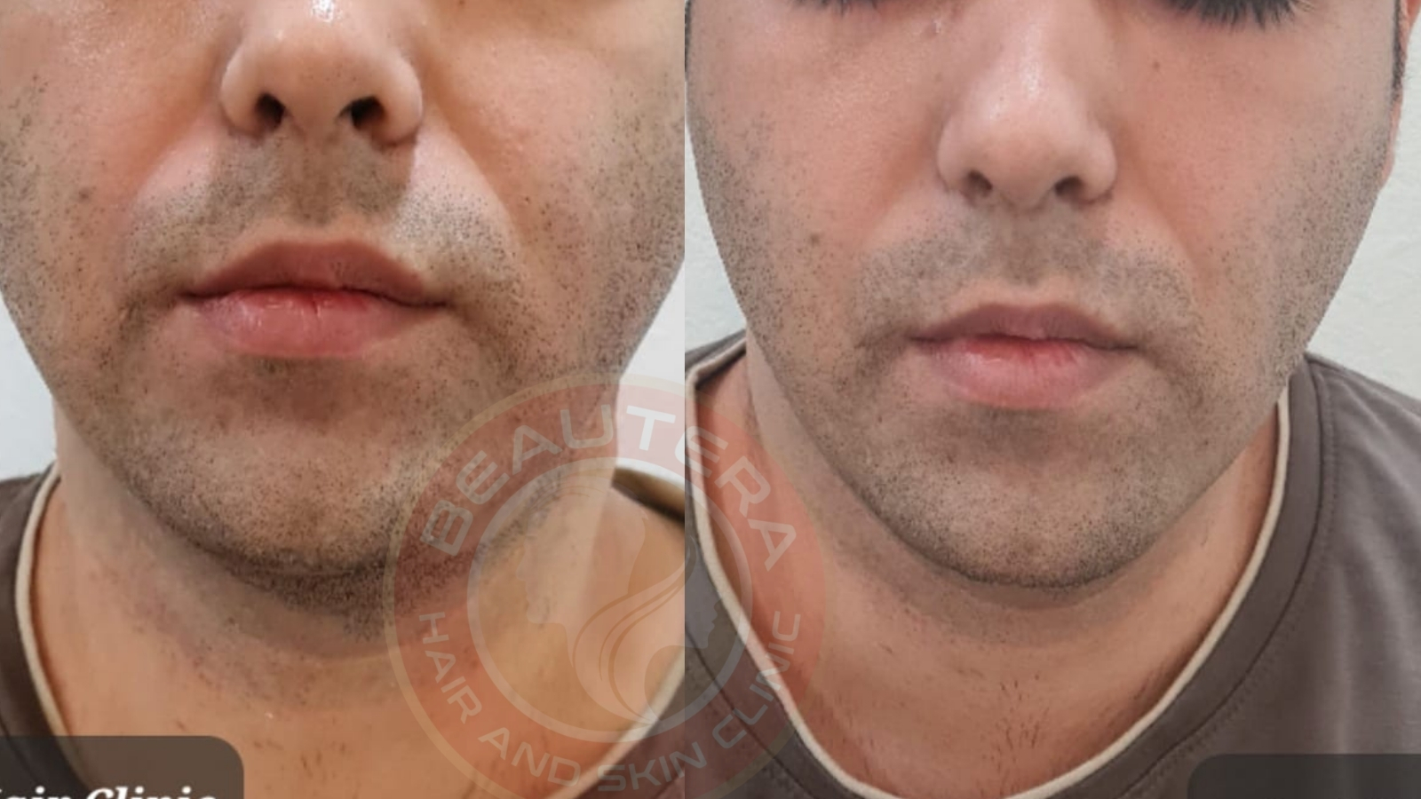 Best HIFU Treatment in Kandivali Mumbai - Antiaging Treatment