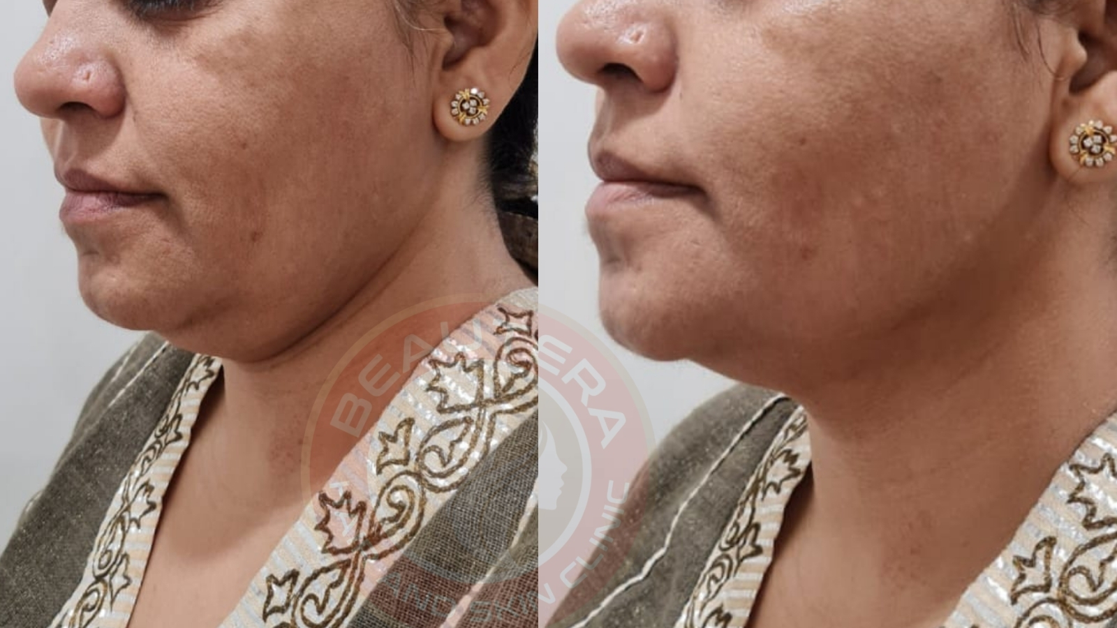 Best HIFU treatment in Kandivali Mumbai