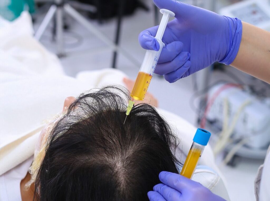 Who should opt for Mesotherapy