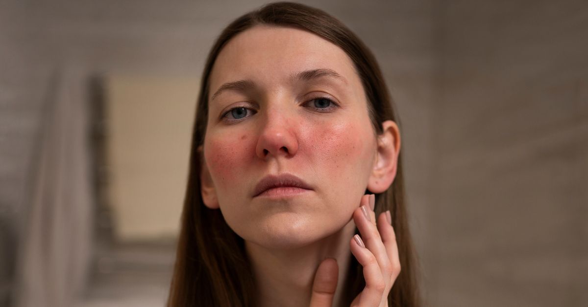 Monsoon Skin Allergies