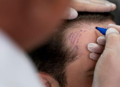 _Hair Transplant